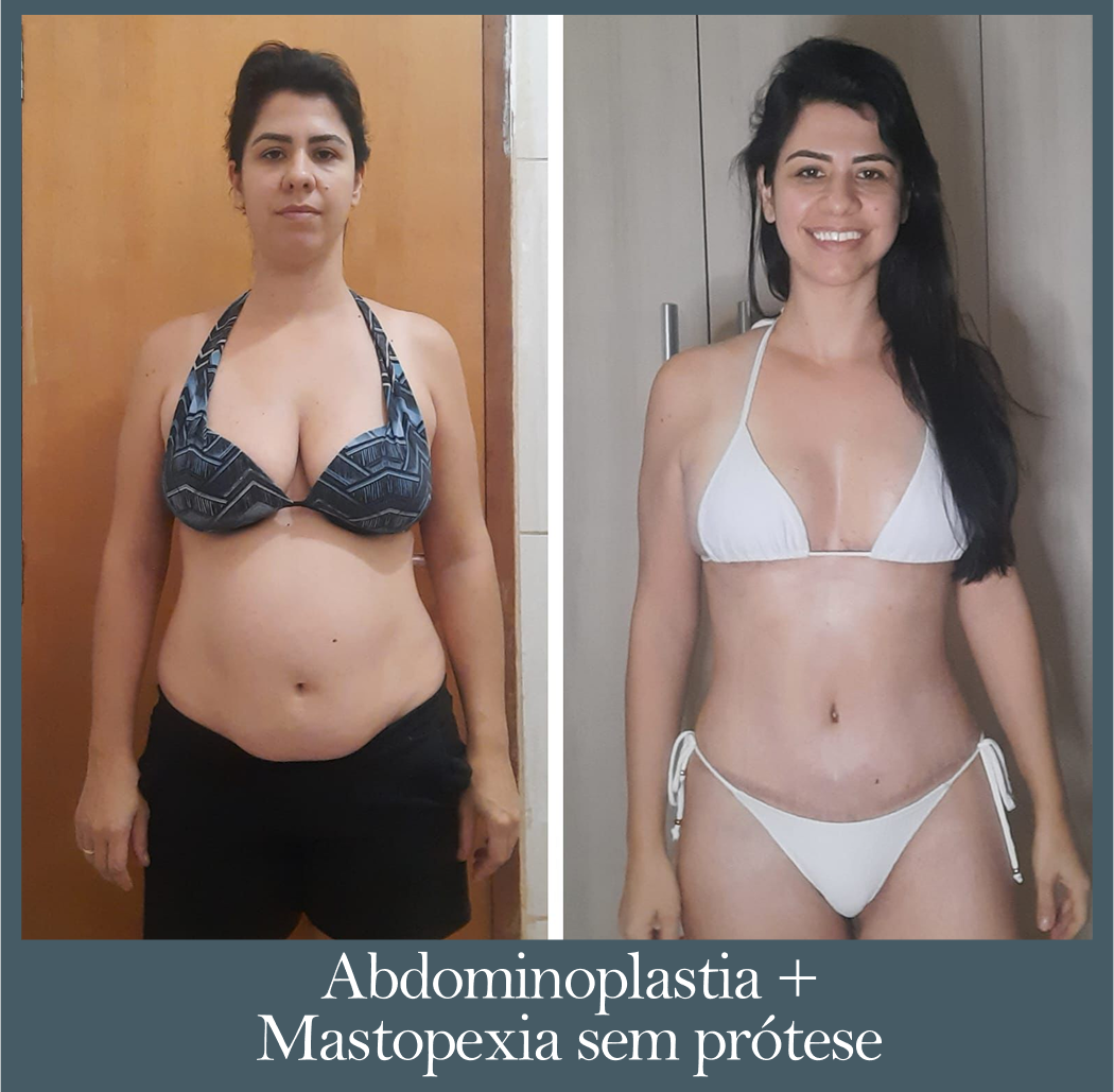 Abdominoplastia + mastopexia sem prótese - Antes e Depois