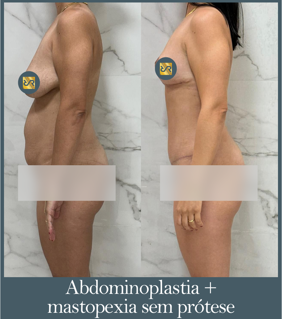 Abdominoplastia + Mastopexia sem prótese - Antes e Depois