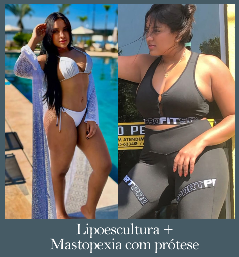 Lipoescultura + Mastopexia com prótese - Antes e Depois