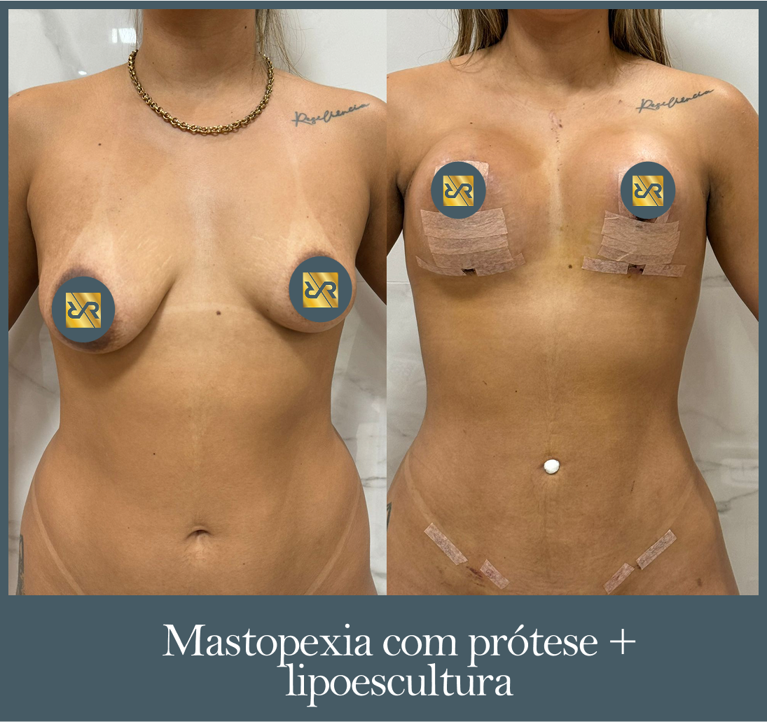 Mastopexia com prótese + lipoescultura - Antes e Depois